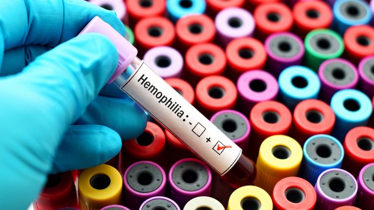 Novo tratamento para hemofilia A é aprovado pela ANVISA