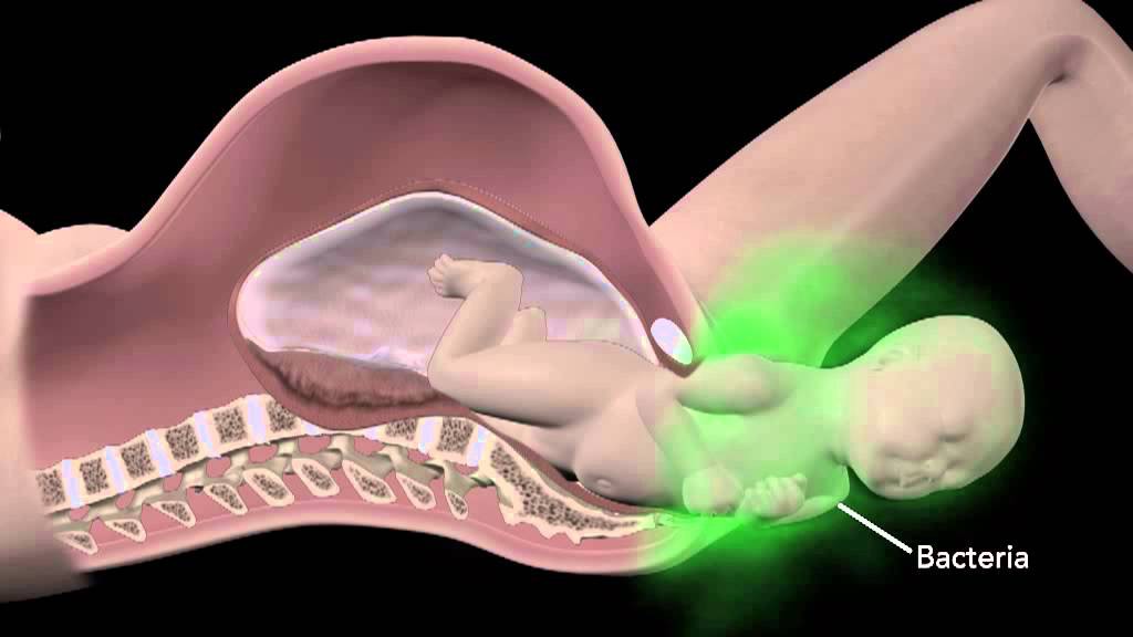 Pesquisa Positiva para Streptococcus agalactiae