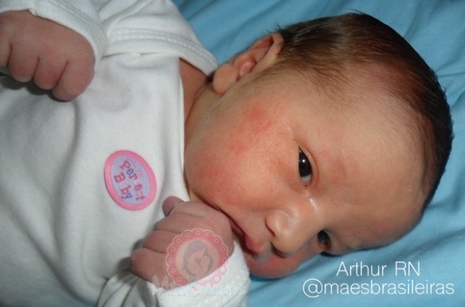 Conheça e trate os problemas de pele mais comuns em bebês Brotoejas