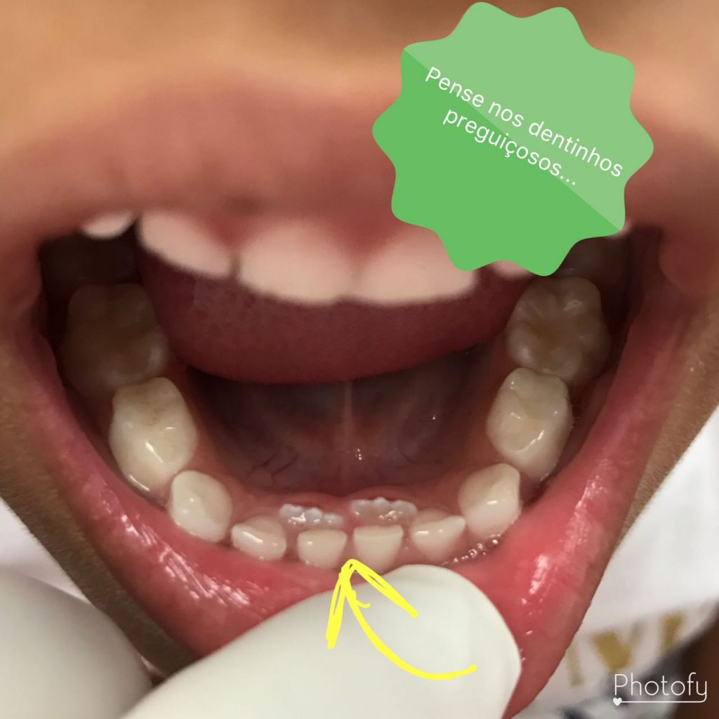 Featured image of post Dente Encavalado Infantil