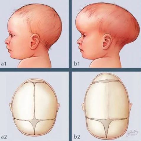 cranioestenose (ou craniossinostose)